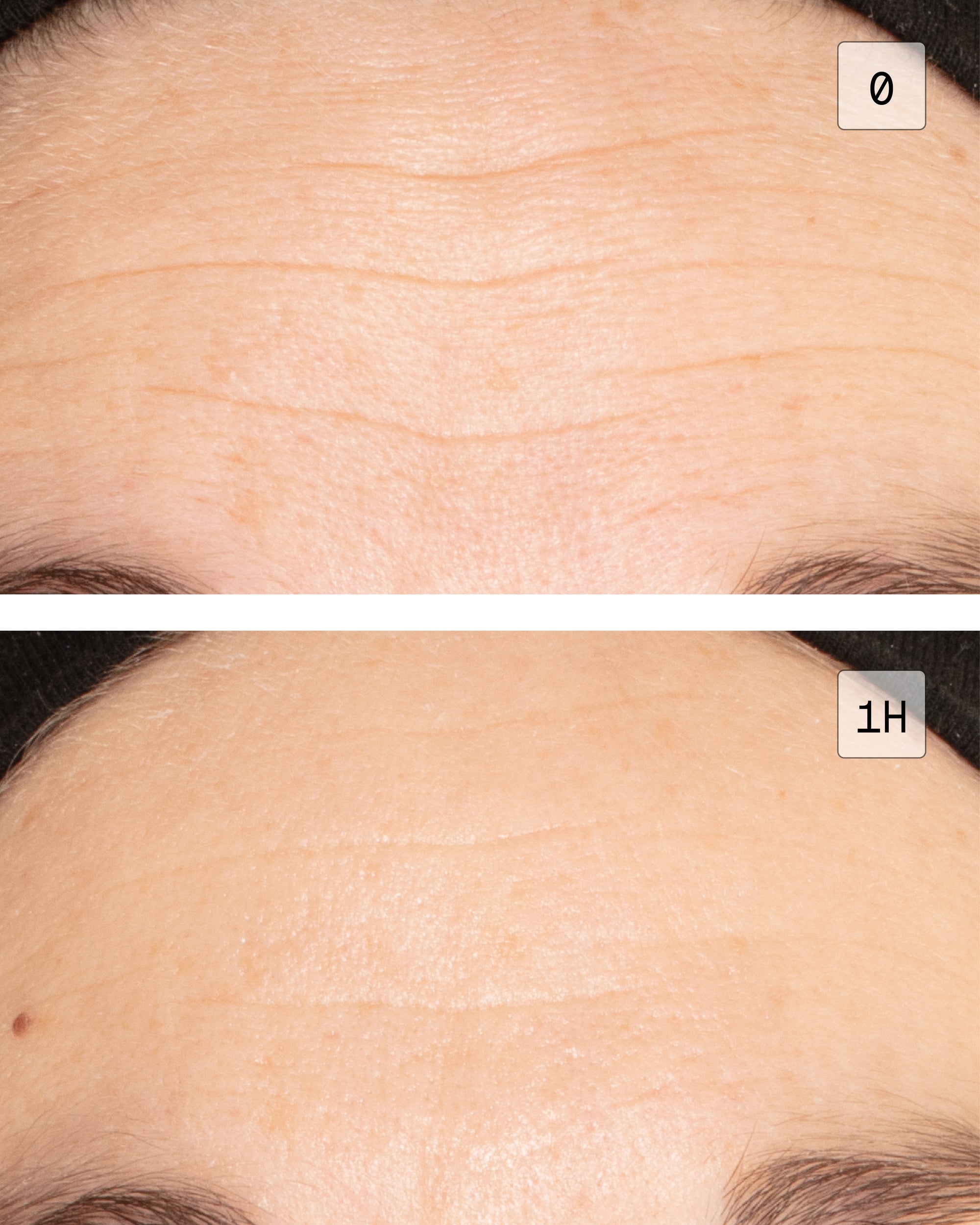 Injection-Free Wrinkle & Lip Plumping Duo